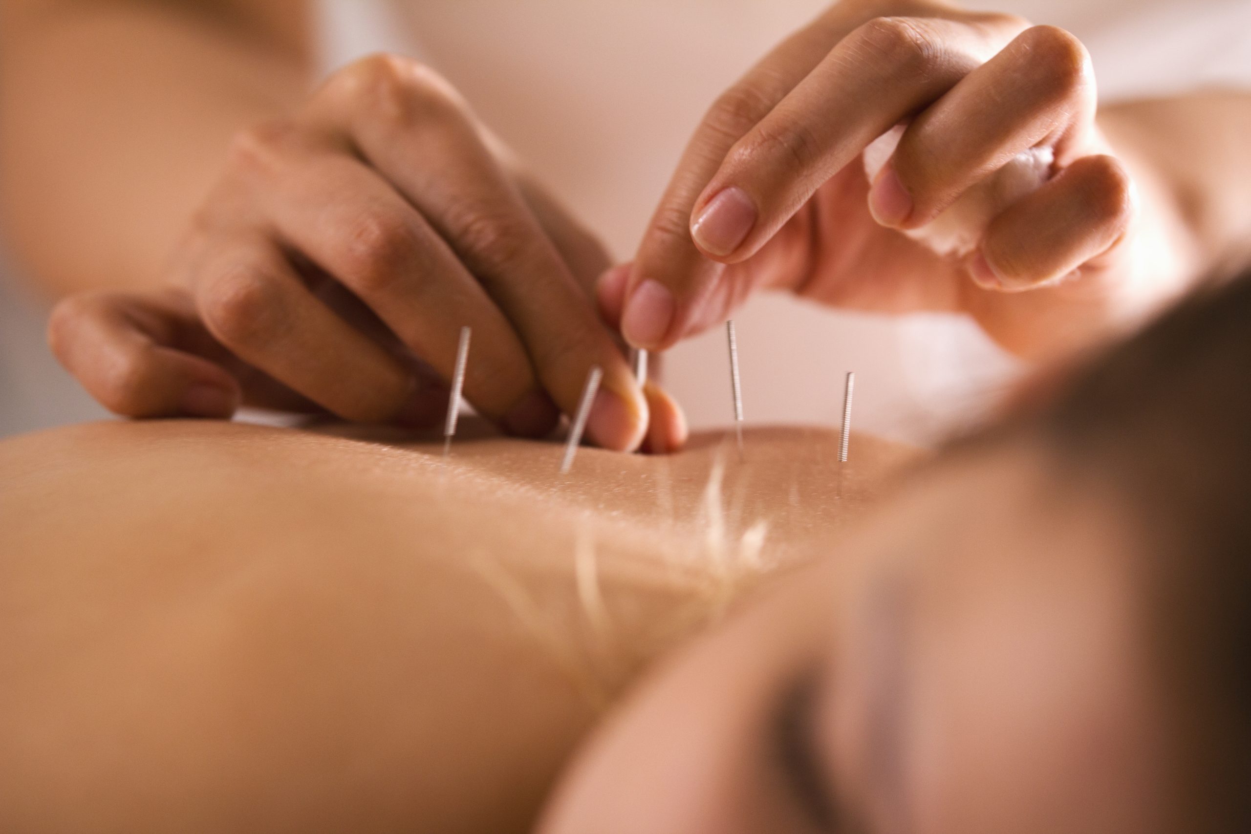Akupunktur – Hvorfor virker det egentlig?