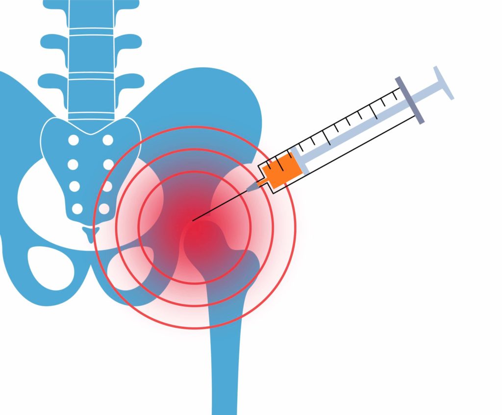 Illustrasjon som viser kortison injeksjon i hoften